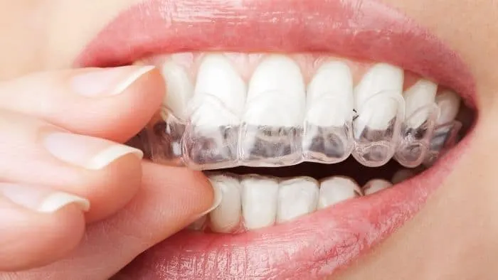 teeth whitening for teens - tray gel